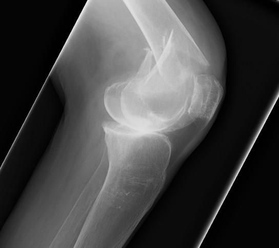 Distal Femoral Fracture